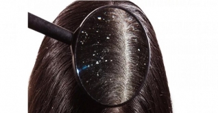 সাধারণ উপায়ে শীতেও খুশকি মুক্ত থাকুন সাধারণ উপায়ে শীতেও খুশকি মুক্ত থাকুন