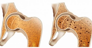 নারীরা হাড় ক্ষয় এড়াতে যা করবেন
