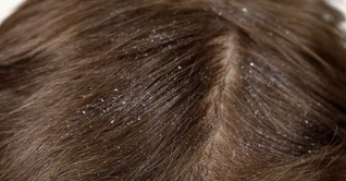 চুল খুশকি মুক্ত রাখতে যা করবেন চুল খুশকি মুক্ত রাখতে যা করবেন