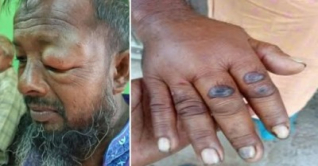 অ্যানথ্রাক্স: আতঙ্ক নয় প্রয়োজন সচেতনতা