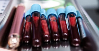 স্তন ক্যানসার চিকিৎসায় ‘গেম-চেঞ্জার’ নতুন এক পরীক্ষা স্তন ক্যানসার চিকিৎসায় ‘গেম-চেঞ্জার’ নতুন এক পরীক্ষা