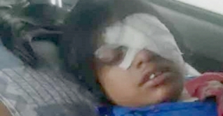 শিক্ষকের বেতের আঘাতে চোখ হারাচ্ছে ছাত্রী