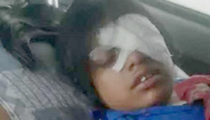 শিক্ষকের বেতের আঘাতে আহত ছাত্রী হাবিবা আক্তার। ছবি : সংগৃহীত