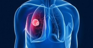 দেশে বাড়ছে ফুসফুসের ক্যান্সারে আক্রান্ত রোগী, দায়ী বায়ু দূষণ