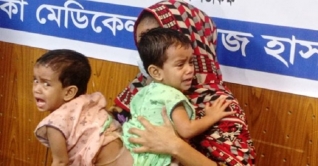 জোড়া শিশু লামিসা-লাবিবার অস্ত্রোপচার শুরু জোড়া শিশু লামিসা-লাবিবার অস্ত্রোপচার শুরু