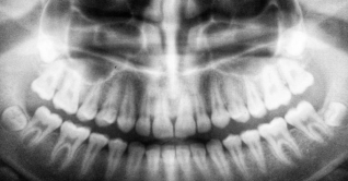 মানুষ ও জীবাণুর লড়াইয়ের ইতিহাস বলছে কঙ্কালের দাঁত
