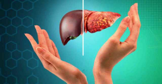 ফ্যাটি লিভার: লক্ষণ ও করণীয় জানুন