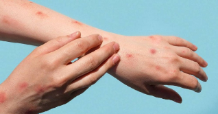 মাঙ্কিপক্স হলে ঠিক কোন কোন লক্ষণ দেখা যায়