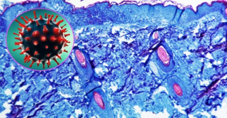 বিশ্বে প্রথম একই সময়ে করোনা-মাঙ্কিপক্সে আক্রান্ত রোগী শনাক্ত