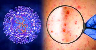 মাঙ্কিপক্স ঠেকাতে যে পরামর্শ দিচ্ছেন জার্মানির বিশেষজ্ঞরা