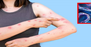 মাঙ্কিপক্স কী, লক্ষণ ও প্রতিরোধের উপায় জানুন 