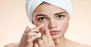 ত্বকের ব্রণ-কালো দাগ দূর করার নতুন উপায় ত্বকের ব্রণ-কালো দাগ দূর করার নতুন উপায়