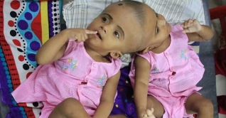 আজ হাঙ্গেরিতে রাবেয়া-রোকাইয়ার প্রথম অপারেশন আজ হাঙ্গেরিতে রাবেয়া-রোকাইয়ার প্রথম অপারেশন