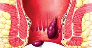 বিশ্বে প্রায় ১০ লাখ নারী ফিস্টুলায় ভুগছে, দেশে ২০ হাজার