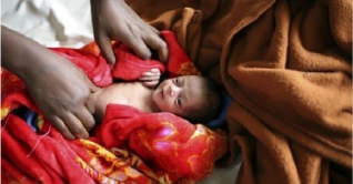 দেশে সিজারের মাধ্যমে শিশু জন্মের হার বেড়েছে